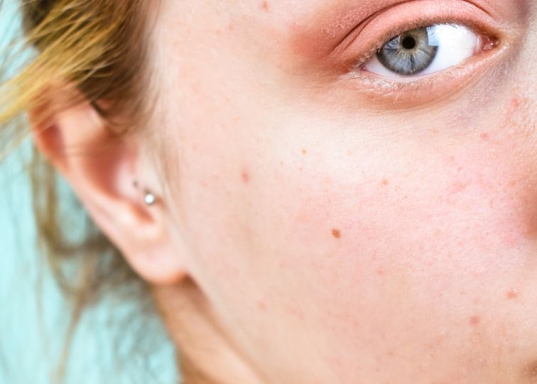 girl face skin up close