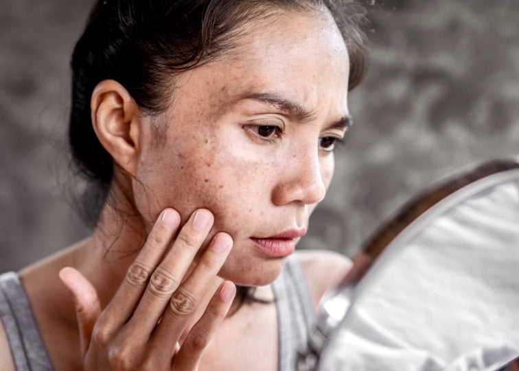 women with dark spots