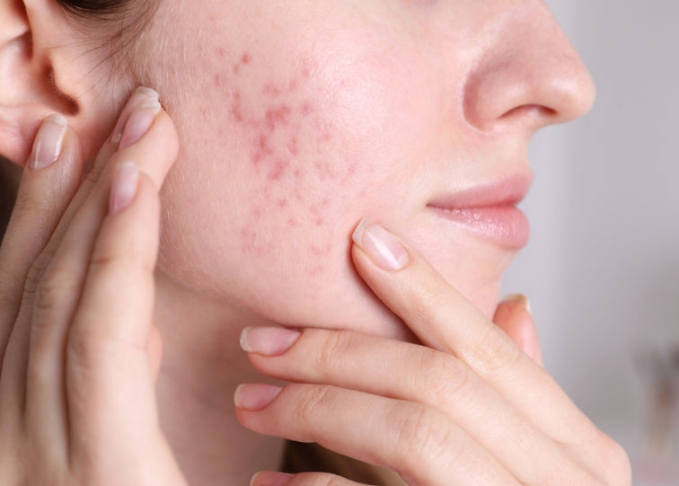 Acne scars on women