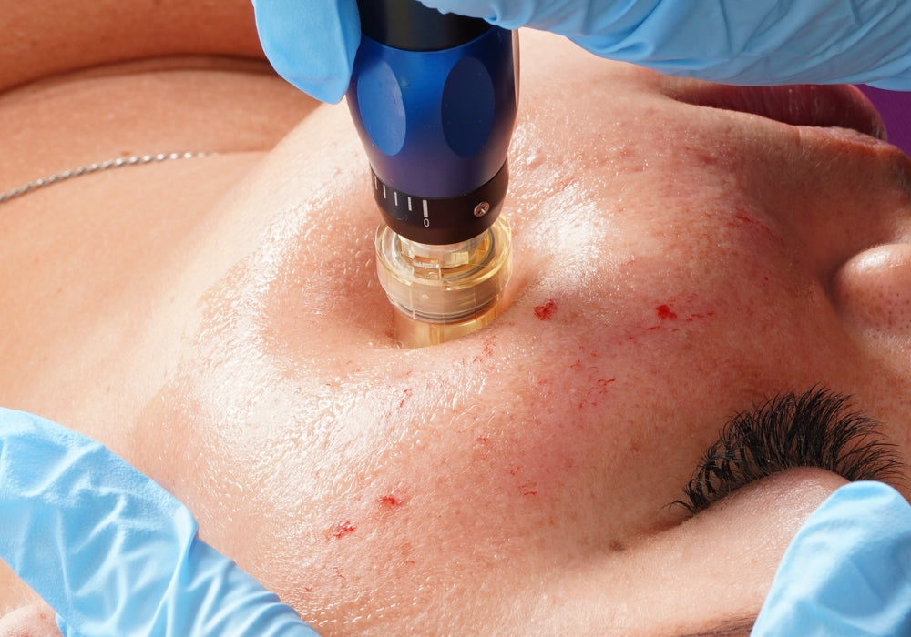 Skincare Ingredients to Avoid After Microneedling