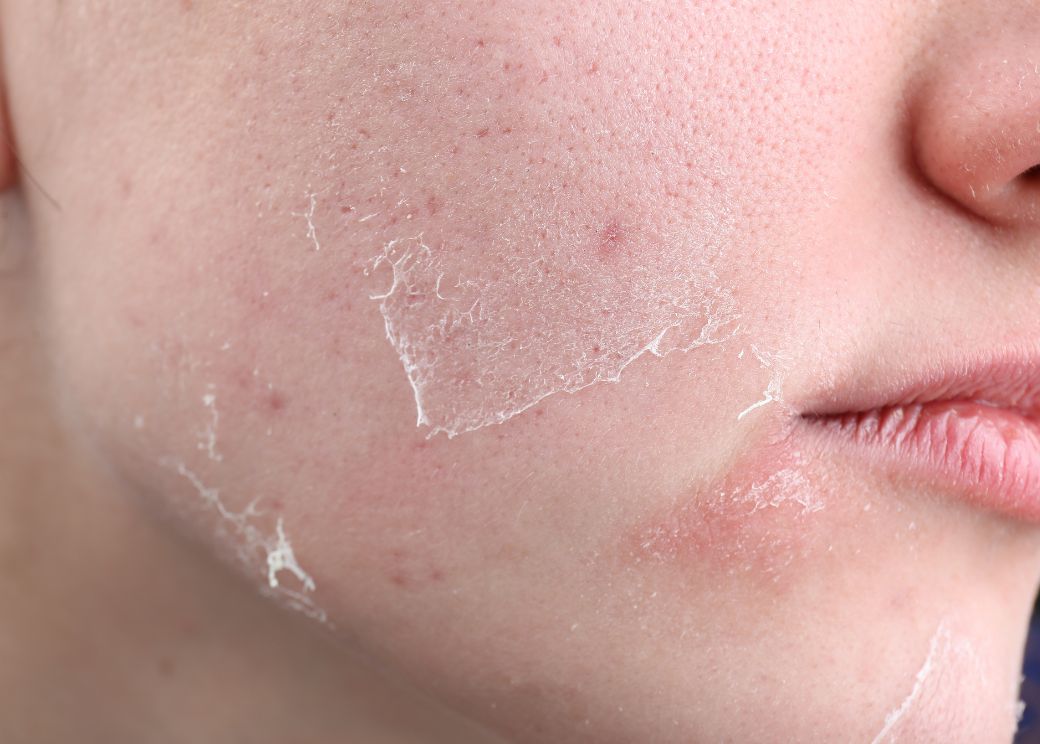 dry skin up close