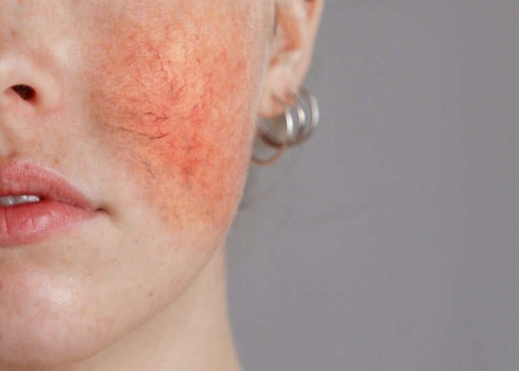 women with rosacea