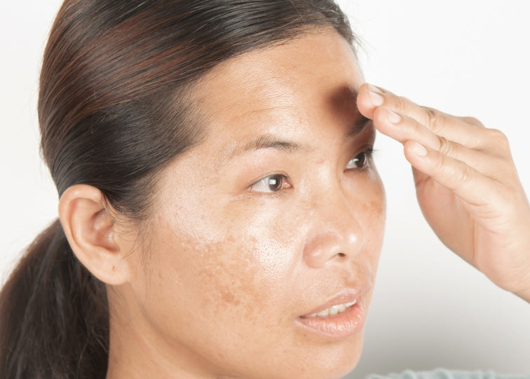 women with hyperpigmentation