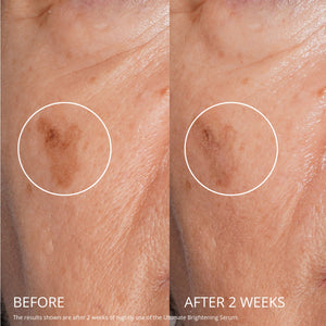 Before and after comparison of skin with a spot, showing improvement after two weeks of use.