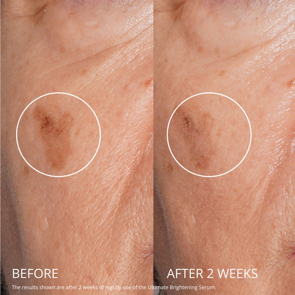 Before and after comparison of skin with a spot, showing improvement after two weeks of use.